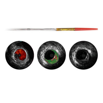 Eagle Eye Platinum — цифровой катетер для всузи