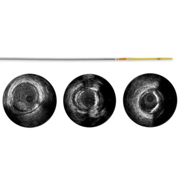 Refinity — ротационный катетер для проведения всузи