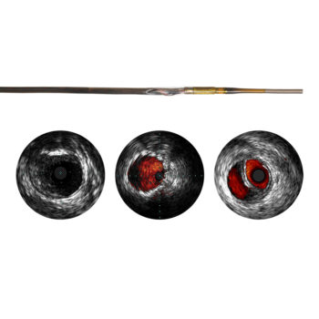 Visions PV (0,018 дюйма) — цифровой катетер для ВСУЗИ